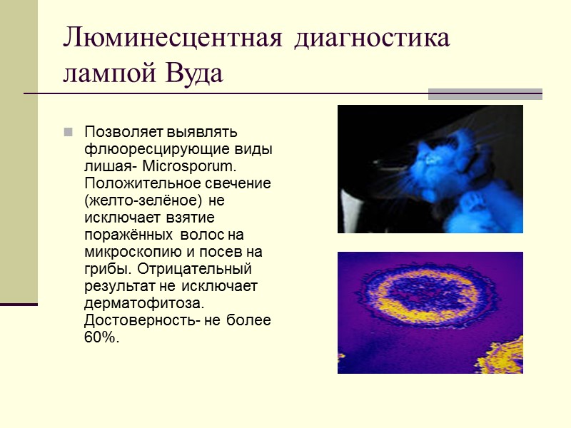 Люминесцентная диагностика лампой Вуда  Позволяет выявлять флюоресцирующие виды лишая- Microsporum. Положительное свечение (желто-зелёное)